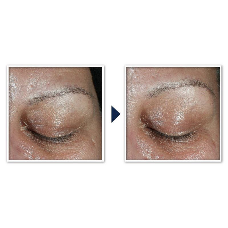 slide 2 of 7, RoC + Derm Correxion Advanced Retinol & Peptides Dual Eye Cream 2 - 0.34 fl oz Each, 2 ct